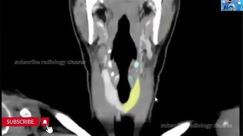 Ct Scan Neck Anatomy Next Episode Ct Neck Filiming Youtube