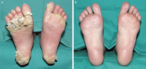 Plantar warts stats and facts. Severe Plantar Warts in an Immunocompromised Patient | NEJM