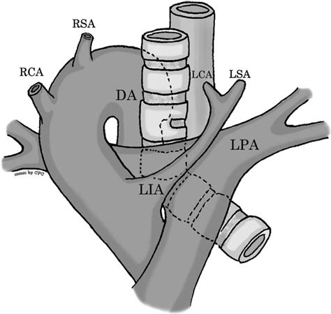 The Anatomy Of The Right Aortic Arch With Mirror Image Branching Da ¼