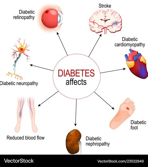 Diabetes Affects Complications Of Royalty Free Vector Image