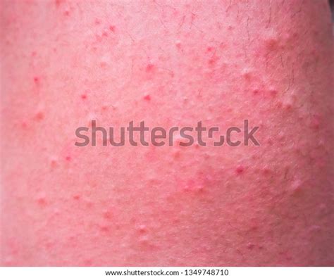 Skin Itching Rashred Spots On Skinred Stock Photo Edit Now 1349748710