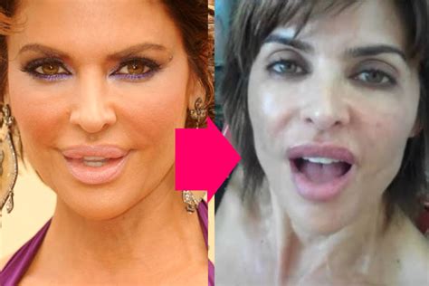 Lisa Rinna Lips Before And After