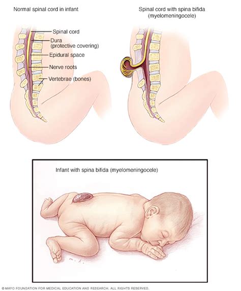 Spina Bifida Symptoms And Causes Artofit