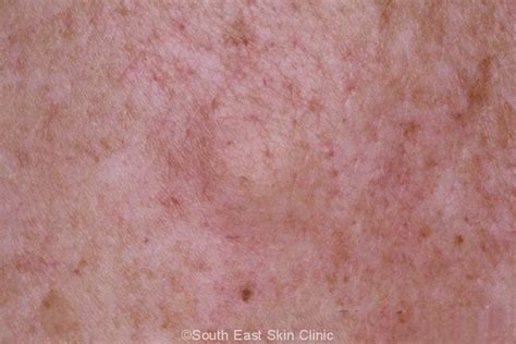 Atypical Fibroxanthoma South East Skin Clinic