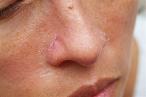 How To Get Rid Of Red On The Side Of The Nose Healthy Living