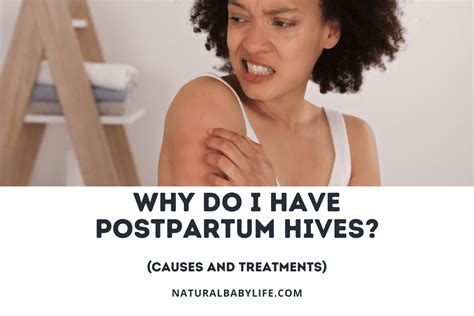 Why Do I Have Postpartum Hives Causes And Treatments