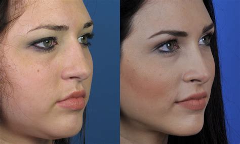 An Overview On Rhinoplasty Recovery How Long Does It Take To Recover
