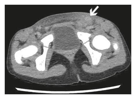Enhanced Computed Tomography Findings A Pelvic Enhanced Computed