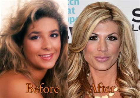 If you have already had heather dubrow before and after plastic surgery and want: Alexis Bellino Plastic Surgery Before and After Boob, Nose ...