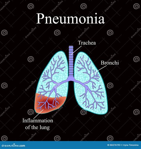 Pneumonia The Anatomical Structure Of The Human Lung Stock Vector