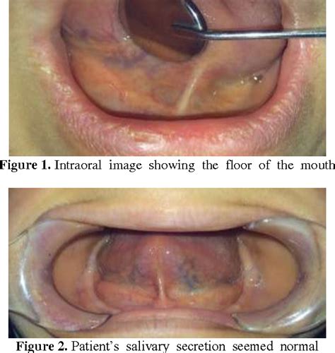 Figure 6 From Two Cases Of Submandibular Sialolithiasis Detected By