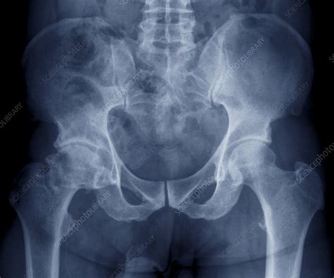Osteoarthritis Of The Hip X Ray Stock Image C0095441 Science