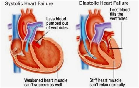Heart Failure Causes Symptoms And Signs Health And Medical Information