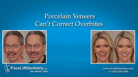In the former, only front teeth of the upper jaw have protruded outside. Porcelain Veneers Can't Correct Overbites - YouTube