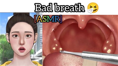 Cause Of Bad Breath Tonsil Stone Removal Animation Asmr Youtube