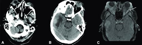 A B Computed Tomography Showing Marked Bilateral Orbital Soft Tissue