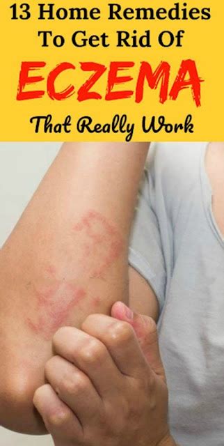 13 Home Remedies To Get Rid Of Eczema Fast That Really Work Wellness