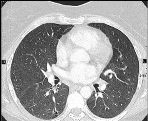 Pulmonary Langerhans Cell Histiocytosis Imaging Appearance And