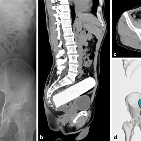 Transanal Manual Removal Of The Foreign Body A X Ray Fluoroscopy