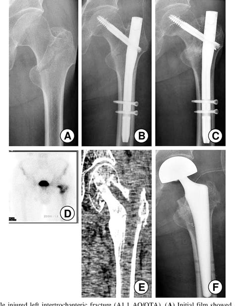 Pdf Treatment Of Intertrochanteric Fracture Of The Femur Using A Dyna