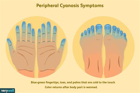 Peripheral Cyanosis Symptoms Causes And Treatment
