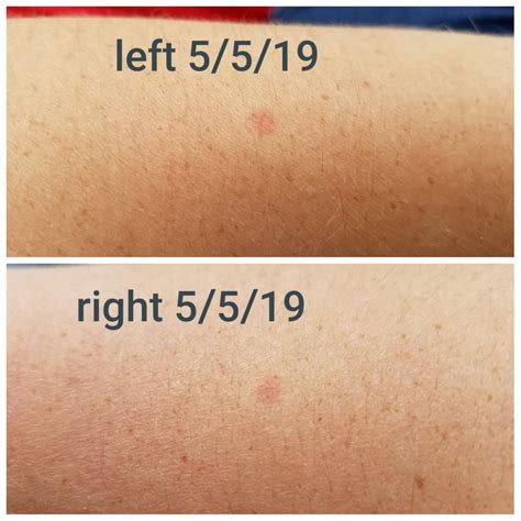 Red Spots On Forearm