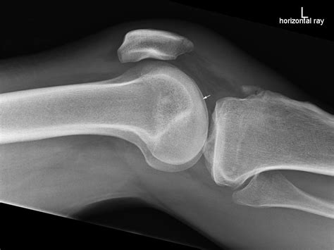 Lateral Knee Radiography Wikiradiography
