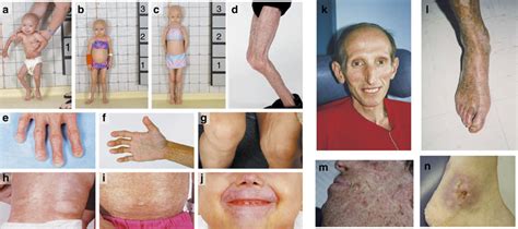 Clinical Features Of Progeroid Syndromes Aj Hutchinson—gilford