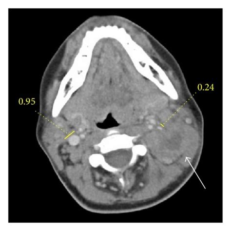 Head And Neck Ct Scan Of Neck Lymph Nodes My Xxx Hot Girl