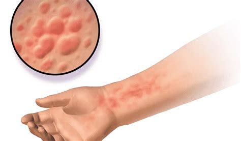 Hives Causes Symptoms Diagnosis Treatment And Prevention