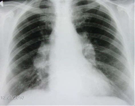 Chest Radiograph Demonstrates Bilateral Hilar Lymphadenopathy Typical