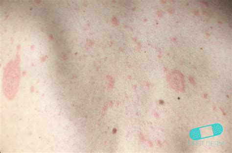 Who get affected by viral rashes? Online Dermatology - Pityriasis Rosea