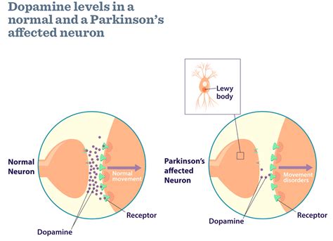 What Is Parkinsons Disease Causes Signs Symptoms And Treatments