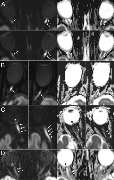 Examples Of Dwi Mri In 4 Patients With Gca And Arteritic Ion Involving