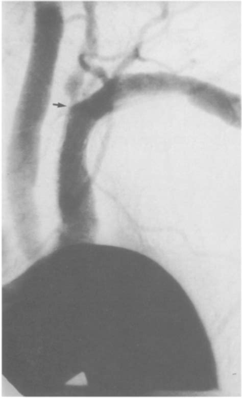 Figure 3 From Recurrent Coronary Subclavian Steal Syndrome Treated By