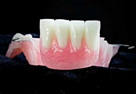 Removable Denture Dental Lab