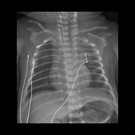 Premature Infant After Picc Placement Pediatric Radiology Case