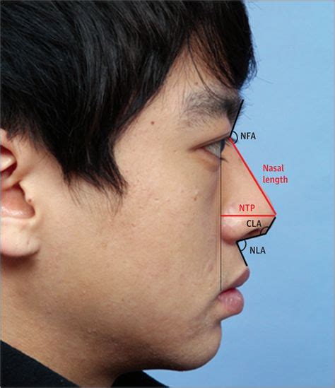 Rhinoplasty For Short Noses In Asians이미지 포함
