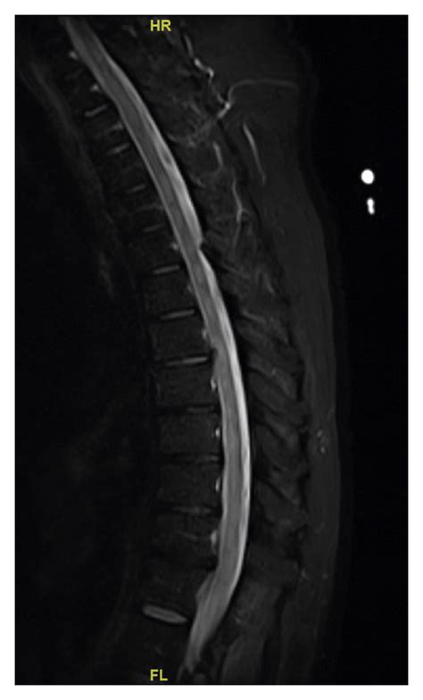 Mri Spine T2 Weighted Sagittal Image Showing Evidence Of Longitudinally