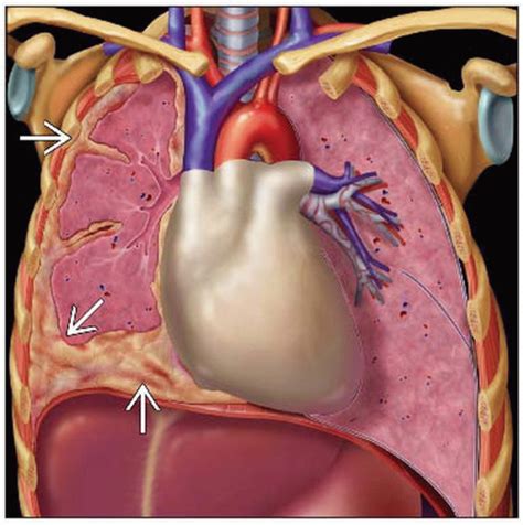 Check spelling or type a new query. Mesothelioma | Radiology Key