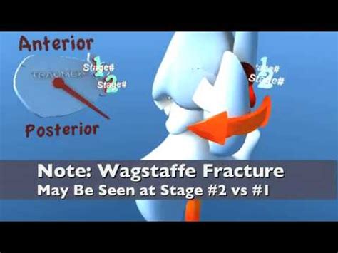 Lauge Hansen SER Supination External Rotation (Eversion ...