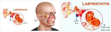 What Is The Definition Of Labyrinthitis Definition Knowing