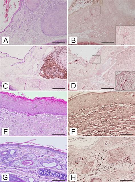 Auricular Pinna Cat A Fibrosarcoma Hyperplastic Epidermis With