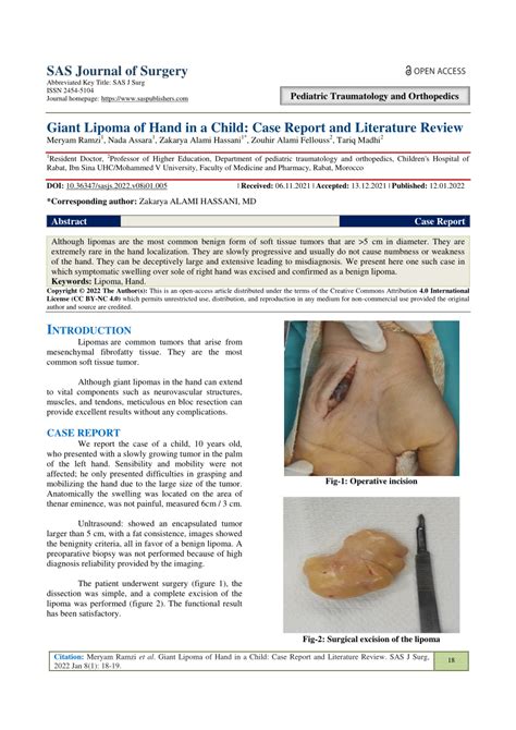 Pdf Giant Lipoma Of Hand In A Child Case Report And Literature Review