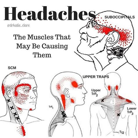 Tension Headaches💫 Most Of Us Are Familiar With Tension Headaches