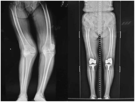 A Lateral Parapatellar Approach With Iliotibial Band Dissection From