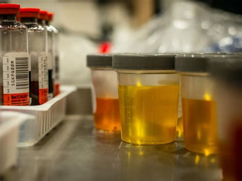 Urinalysis Tests Results And More