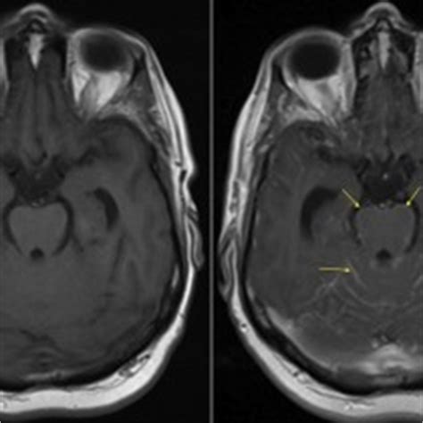 We did not find results for: Pleural Mesothelioma With Brain Metastases