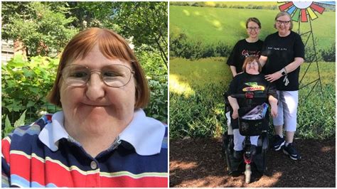 Disability Blogger Trolls Said I Was Too Ugly For Selfies So I Hit