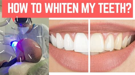 How To Whiten My Teeth Instantly Teeth Whitening In Cartagena How